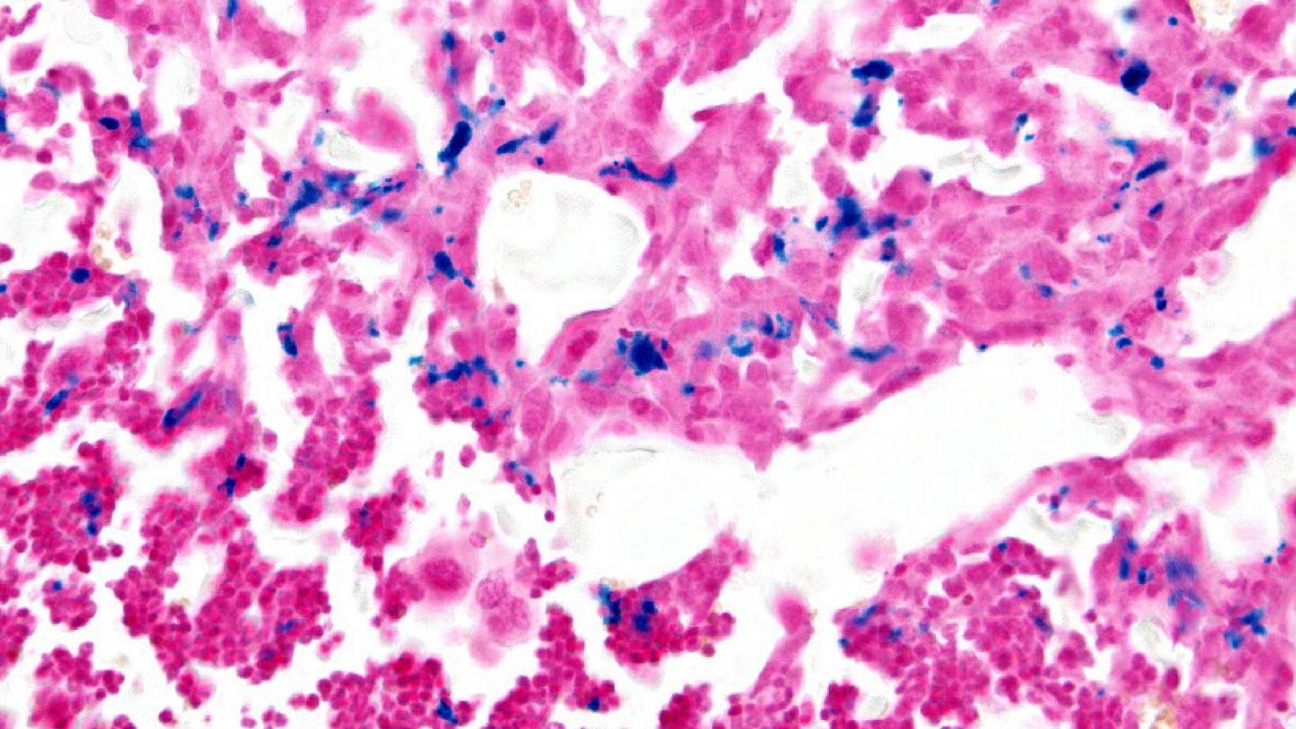 Cancer cells